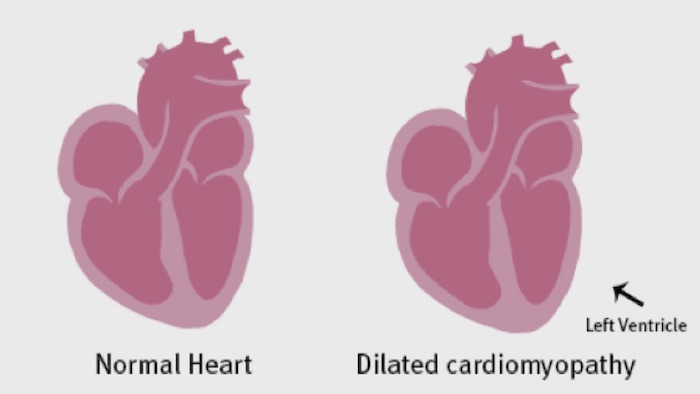 Mutaciones que causan cardiomiopatía dilatada