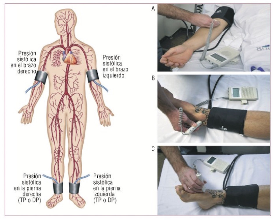 Estatinas: bajan el riesgo en enfermedad arterial periférica asintomática